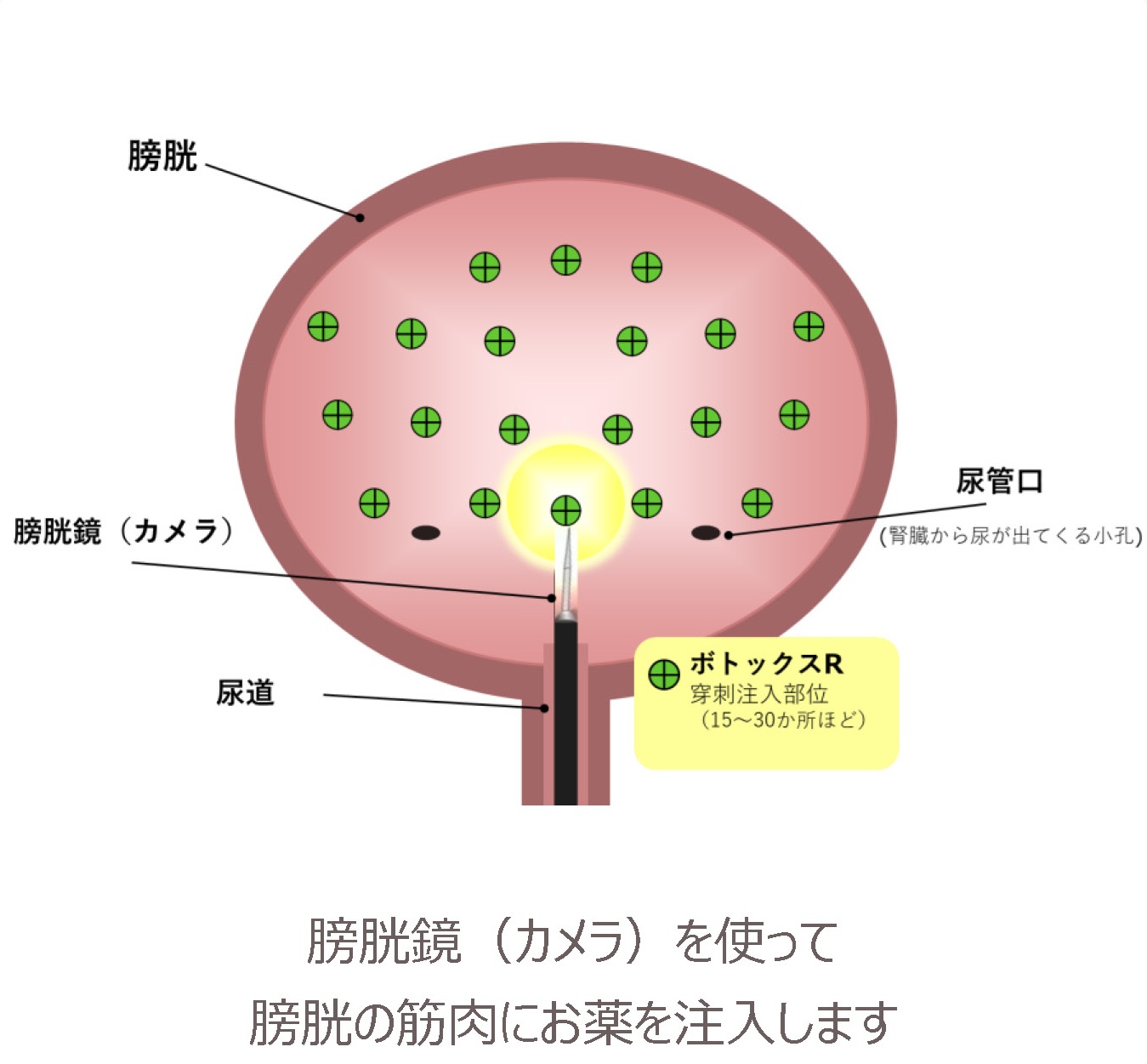 膀胱鏡（カメラ）を使って膀胱の筋肉15〜30か所にボトックスを穿刺注入するしくみ図。膀胱・尿管口・尿道の位置関係も示す。